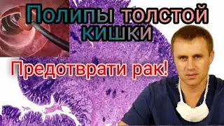 Полипы толстой кишки