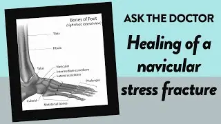 Ask the Doctor: Healing of a navicular stress fracture