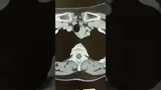 Узел щитовидной железы на КТ.
