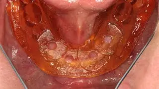 LODI Implant Placement Using an In-Office 3D Printed LODI Surgical Guide