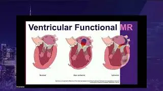 SUN 9 15 Yannis Amador, Carolyn Teng  Echocardiographic Assessment and Surgical Management of Functi