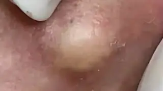 Blackheads & Whiteheads Satisfying Removal @0162