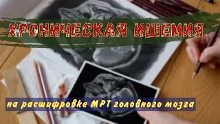 Смешанная ГИДРОЦЕФАЛИЯ, ХРОНИЧЕСКАЯ ИШЕМИЯ головного мозга и ИНСУЛЬТЫ на РАСШИФРОВКЕ МРТ мозга