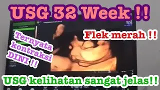 KEHAMILAN USIA 32 WEEK!! FLEK MERAH SAMPAI KONTRKASI!! HAMPIR LAHIR PREMATUR!! WASPADA !N!
