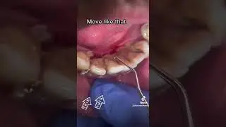 Move like that ! Teeth build up , Tartar