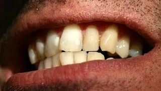 How to Straighten Crooked Teeth | Tooth Care