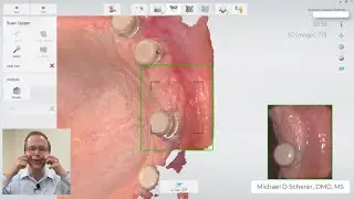 LOCATOR Scan Body! - How to Scan Intraoral Scanning Edentulous Ridges using LOCATOR Scan Bodies