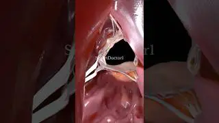✨ Right ventricle 🩺🫀