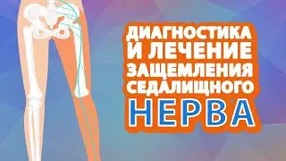 Диагностика и лечение защемления СЕДАЛИЩНОГО НЕРВА // #zdravclinic