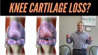 Knee Cartilage Loss: How To Help Knee Cartilage Without Surgery