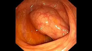 It looks weird. The peristalsis in the colon