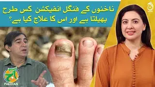 Nail Fungal Infection: Causes, Symptoms, and Treatments - Dr. Kashif Ahmed - Aaj Pakistan