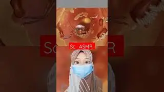 kecoa Masuk Di Telinga 😱😱 |Mv 