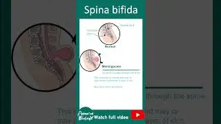 Spina bifida | 1min devbio