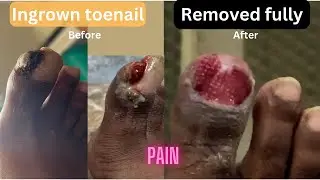 Ingrown Toenail Fully Removed