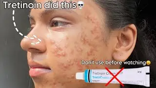 Tretinoin mistakes that ruined my skin 😫 