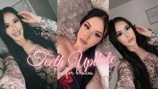 ♡TEETH UPDATE + Tips For Braces♡