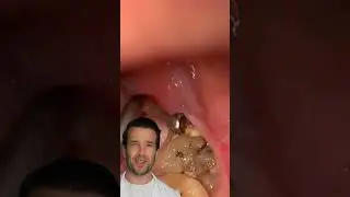 Wisdom tooth pocket 