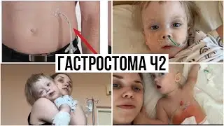 Установка Гастростомы и Осложнения