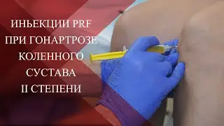 💉PRF методика в лечении паталогий опорно-двигательного аппарата| Гонартроз II степени|   Эпикондилит