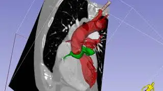 Deep Transgastric Long-Axis Imaging Plane in TEE - En Face View