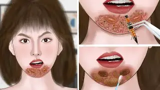 [ASMR Animation] 개미에게 물린 경우 대처 방법 애니메이션 삭제 | Removal Animation