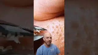 Plucking out pore buildup! #dermreacts #doctorreacts #pores #satisfying