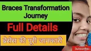 Braces Transformation Journey/Braces journey/Braces Time lapse