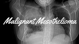 Malignant Mesothelioma
