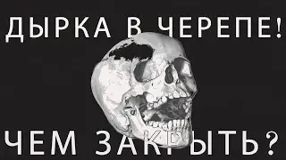 Установкa 3D импланта в череп