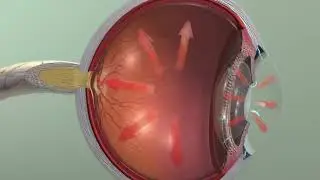 Animation: Glaucoma