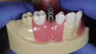 Open Tray Impression - How to take an open tray impression