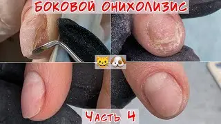 Onycholysis of nails two years ago / Three months later / Part 4