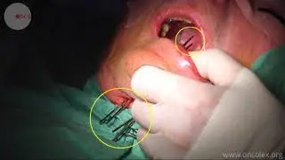 Preparations for Brachytherapy. Placing catheters for tongue brachytherapy