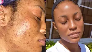 SKINCARE ROUTINE FOR OILY ACNE PRONE SENSITIVE SKIN || How I deal with Hyper Pigmentation & Texture