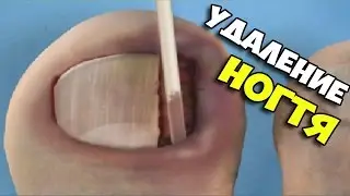 ▶ Симулятор удаления вросшего ногтя (Ingrown Toenail Surgery)