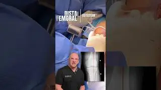 Knock Knees No More - Distal Femur Osteotomy 🔨 #shorts