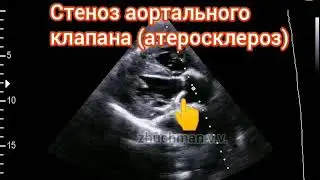 ЭхоКГ стеноз аортального клапана.