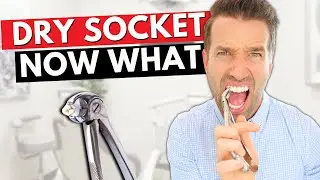 DRY SOCKET - Pain after tooth extraction : causes and cure