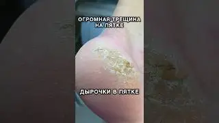 ПАРНЮ 17 лет - пришел с такой проблемой #аленалаврентьева #подолог #подология #обучениеподологии