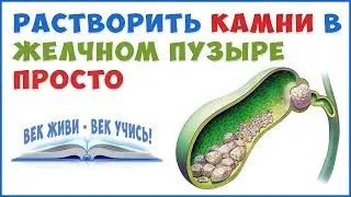 How to Destroyed for Gallstones Without Gallbladder Surgery!