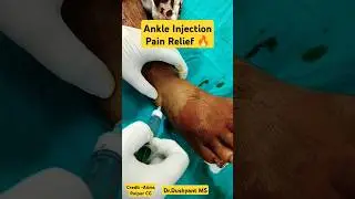 Fast Pain Relief By Ankle Injection 🔥🔥 