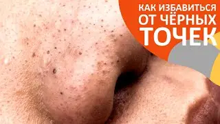 Как избавиться от чёрных точек | Что такое чёрные точки | От чего зависит появление чёрных точек