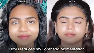 How I Reduced My Forehead Pigmentation with Pond's Anti-Pigmentation Serum | Before & After 