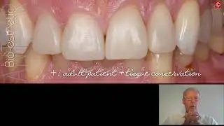 Bio-Esthetics with Freehand Bonding 2.0 - Dr. Didier Dietschi