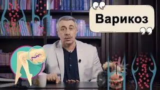 Варикоз.