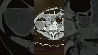 Острая толстокишечная непроходимость на КТ.