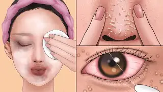 ASMR Makeup Animation | Blackhead care, removal of thread eye discharge