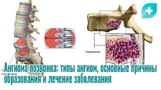 Ангиома позвонка: типы ангиом, основные причины образования и лечение заболевания