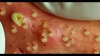 Удаление черных точек 2021 - pimple popping -  blackheads removal - make your day relaxing 001